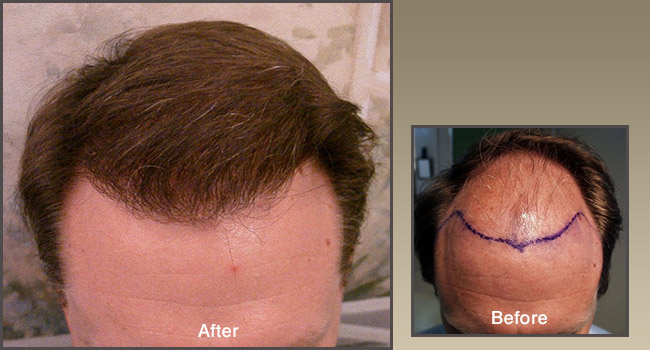 Hair Transplant San Diego | La Jolla Hair Restoration