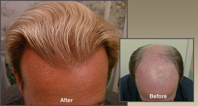 Hair Transplant San Diego | La Jolla Hair Restoration