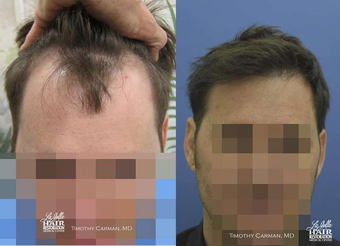 Before and after hairline treatment