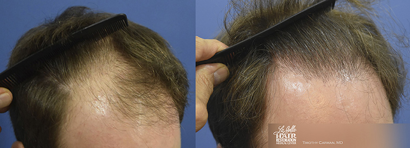 FUT Hair Transplant Case Study – 1849 Grafts at 9 Month Follow Up - Carman,  Timothy ()