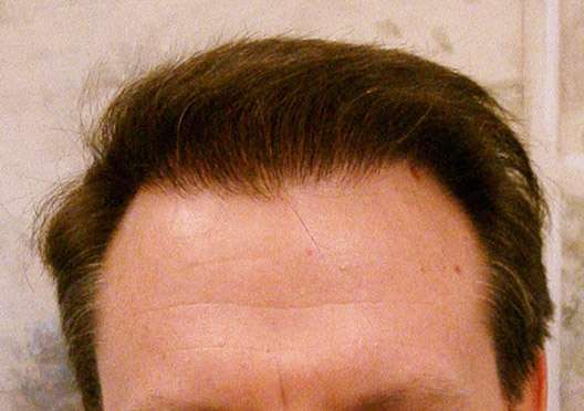 Patient Case Study – 3500 Grafts - Carman, Timothy () Patient Case Study – 3500 Grafts - Carman, Timothy ()
