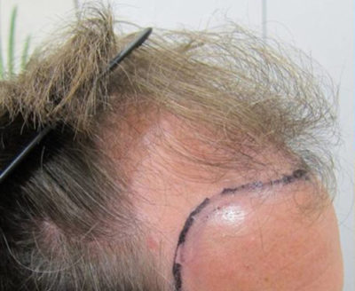 Follicular Unit Excision Before Photo