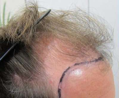 Follicular Unit Excision Before Photo