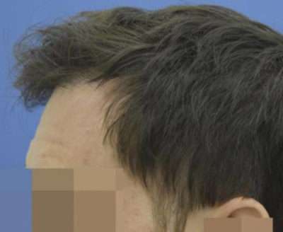 Male Patient Case 255 After Photo Male Patient