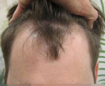 Male Patient Case 255 Before Photo Male Patient