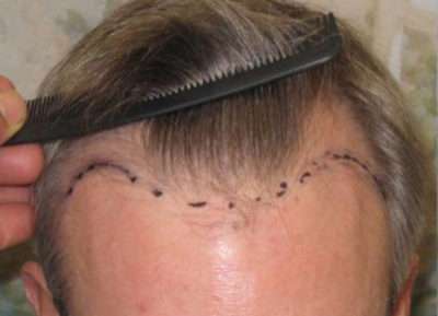 Male Patient Case 252 Before Photo Male Patient
