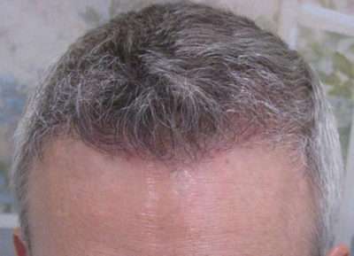 Male Patient Case 252 After Photo Male Patient