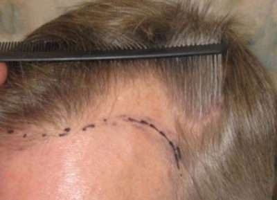 Male Patient Case 252 Before Photo Male Patient