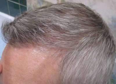 Male Patient Case 252 After Photo Male Patient