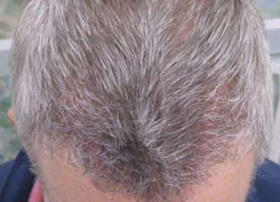 Male Patient Case 252 After Photo Male Patient