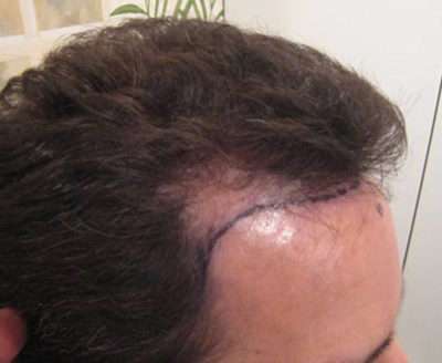 Male Patient Case 250 Before Photo Male Patient