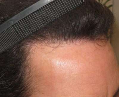 Male Patient Case 250 After Photo Male Patient