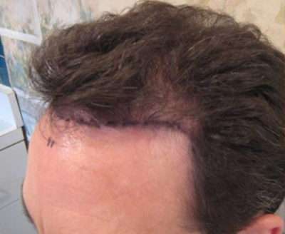 Male Patient Case 250 Before Photo Male Patient
