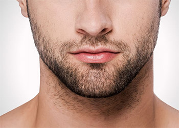 Beard and Mustache Transplantation La Jolla