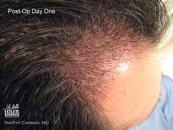 Hair Transplant - Day One