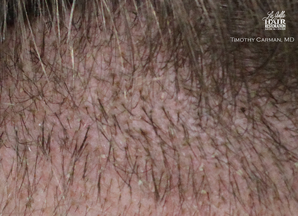Hair Transplant - At two to three weeks, scabs are flaky and translucent, and redness has subsided.
