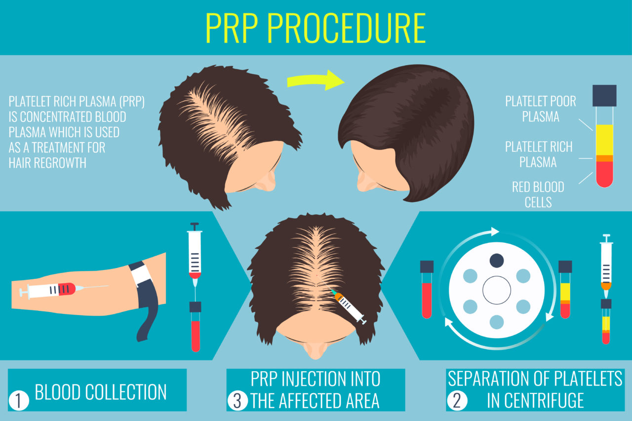 Platelet Rich Plasma (PRP) Therapy for Hair Loss La Jolla | SD