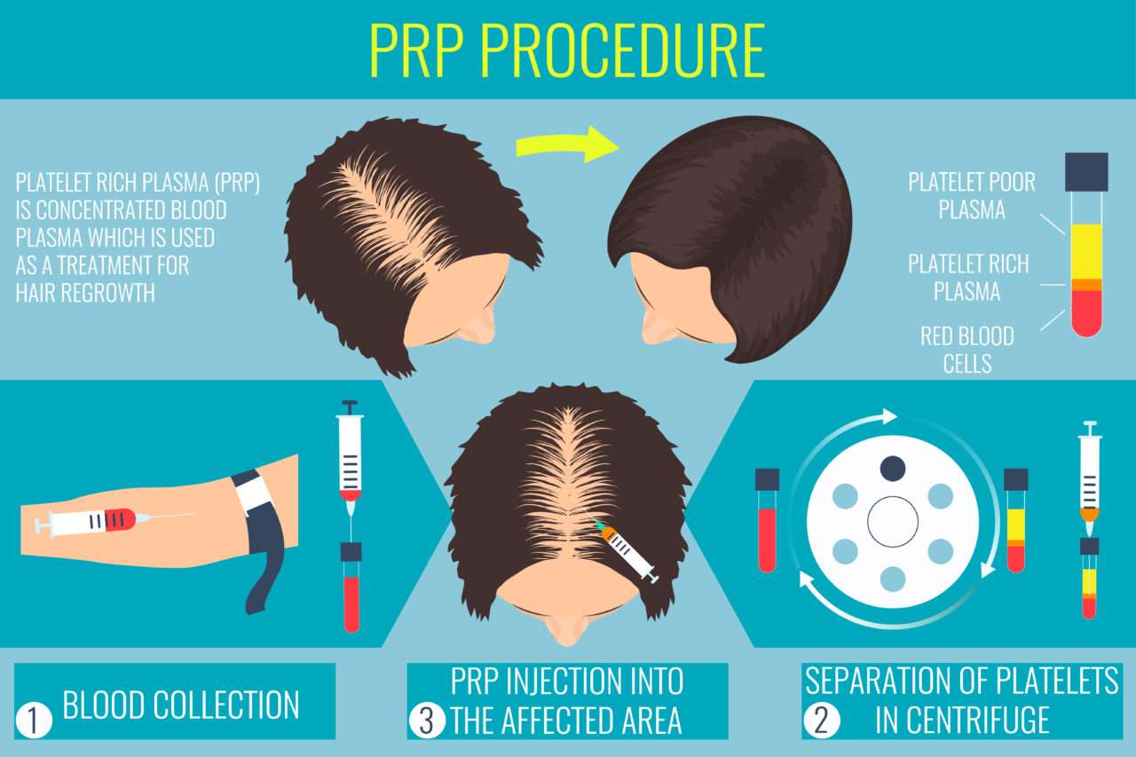 PRP Injections for Hair Loss  Oceanside NY  Long Beach NY