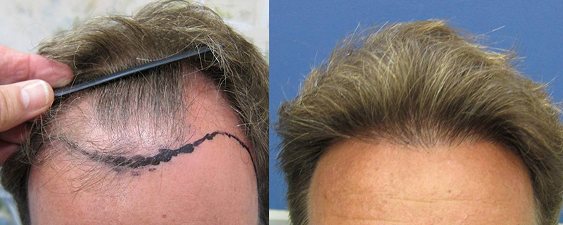 Single Hair Transplantation Before & AFter in la jolla