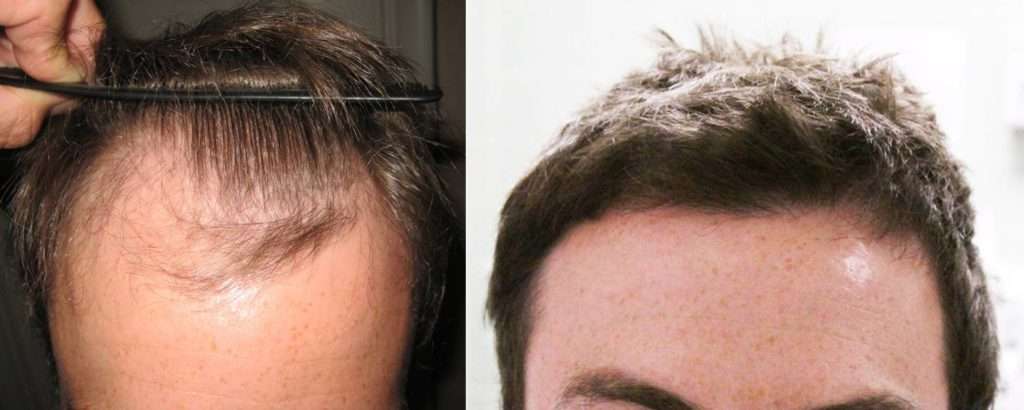 Front View. Norwood Class III Hair Loss Pattern. 1477 Grafts Transplanted vie FUT Hair Transplant Technique in One session. After results are at 12 months. 