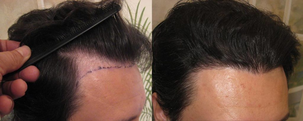 Before & After Hair Transplant Photos La Jolla | Hair Graft Gallery San  Diego