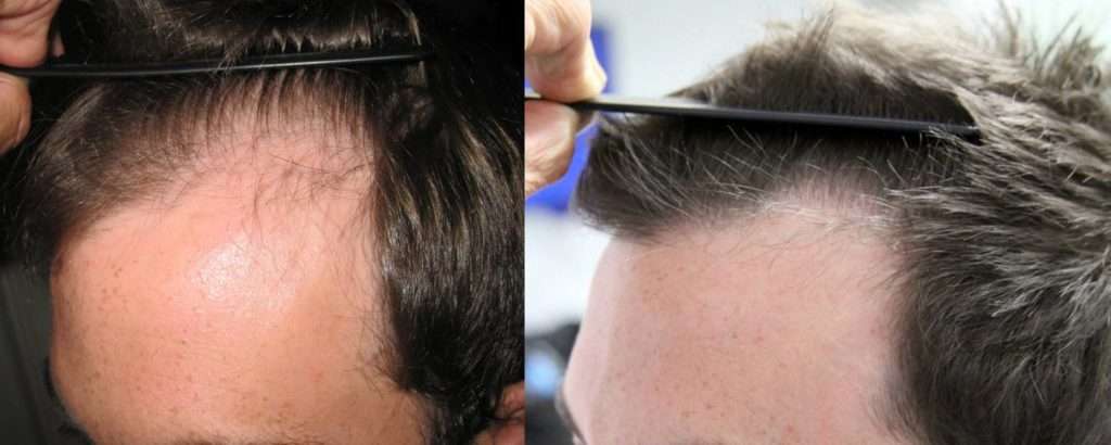 Left Front View. Norwood Class III Hair Loss Pattern. 1477 Grafts Transplanted vie FUT Hair Transplant Technique in One session. After results are at 12 months.