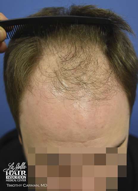 before hair transplant