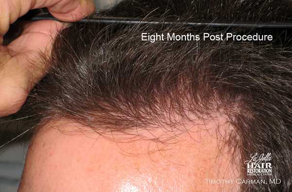 Hair Transplant - Six to Eight Months