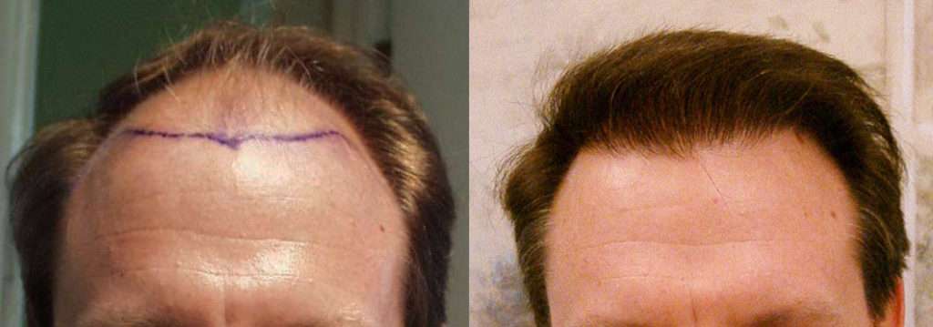 Patient Case Study – 3500 Grafts