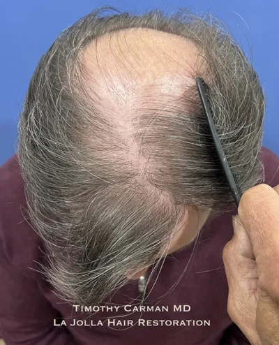 Male Hair Restoration