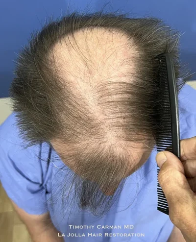 Male Hair Restoration