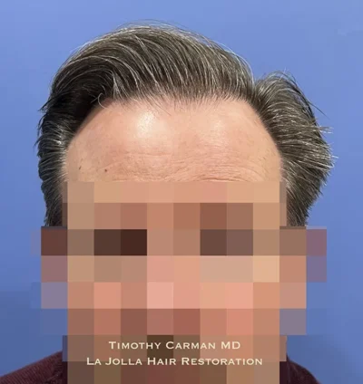 Male Hair Restoration