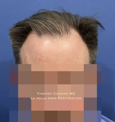 Male Hair Restoration