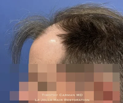 Male Hair Restoration