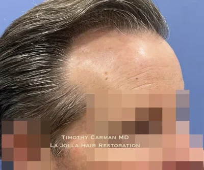 Male Hair Restoration
