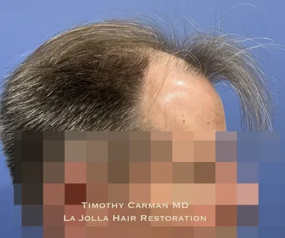 Male Hair Restoration